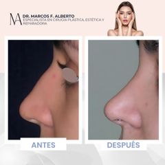 Rinoplastia - Dr. Marcos F. Alberto