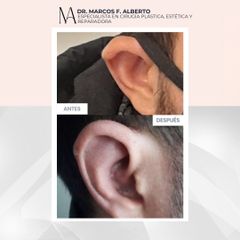 Otoplastia - Dr. Marcos F. Alberto