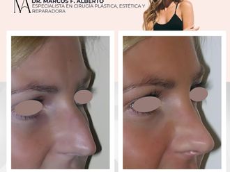 Rinoplastia antes y después - 871367