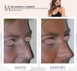 Rinoplastia - Dr. Marcos F. Alberto