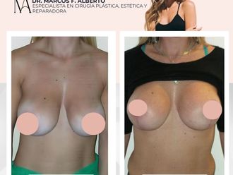 Mastopexia antes y después - 871368