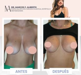 Mastopexia - Dr. Marcos F. Alberto