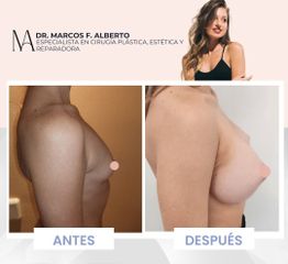 Aumento mamas - Dr. Marcos F. Alberto