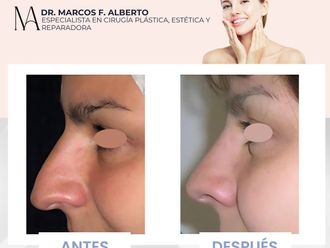 Rinoplastia antes y después - 871373