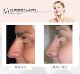 Rinoplastia - Dr. Marcos F. Alberto