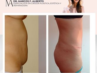 Abdominoplastía antes y después - 871374