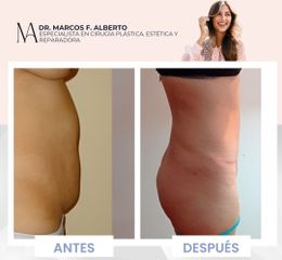 Abdominoplastia - Dr. Marcos F. Alberto