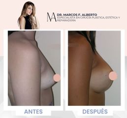 Aumento mamas - Dr. Marcos F. Alberto