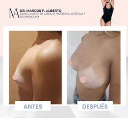 Aumento mamas - Dr. Marcos F. Alberto