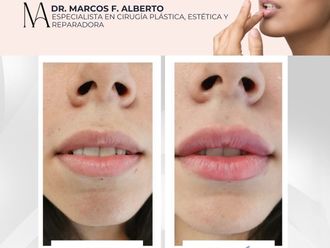 Relleno de labios antes y después - 871377