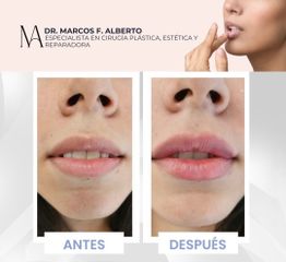 Relleno de labios - Dr. Marcos F. Alberto