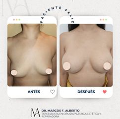 Aumento Mamario - Dr. Marcos F. Alberto
