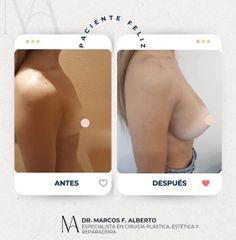 Aumento Mamario - Dr. Marcos F. Alberto