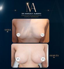 Aumento Mamario - Dr. Marcos Fernando Alberto