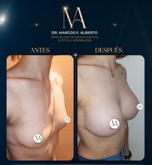 Aumento Mamario - Dr. Marcos Fernando Alberto