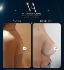 Aumento mamario - Dr. Marcos Fernando Alberto