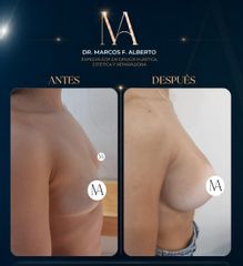 Aumento Mamario - Dr. Marcos Fernando Alberto