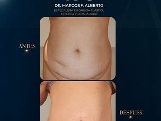 Dermolipectomía antes y después - 881384