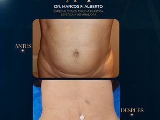 Dermolipectomía antes y después - 881385