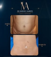 Dermolipectomia - Dr. Marcos Fernando Alberto