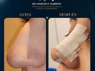 Rinoplastia antes y después - 881386