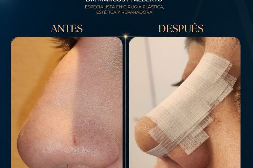 Rinoplastia antes y después - 881386