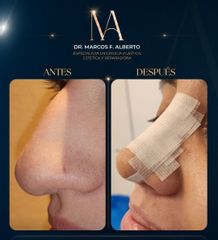 Rinoplastia - Dr. Marcos Fernando Alberto