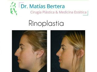 Rinoplastia