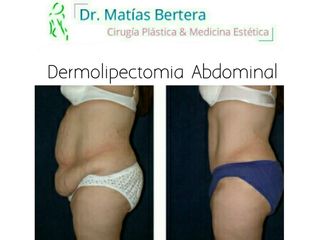 Abdominoplastia Dermolipectomía Dr. Matías Bertera