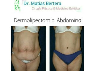 Abdominoplastia Dermolipectomía 