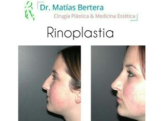 Rinoplastia Rinomodelación Dr. Matías Bertera