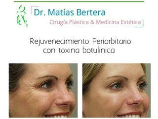 Toxina Botulínica Botox Dr. Matías Bertera - Arrugas - Rejuvenecimiento Facial