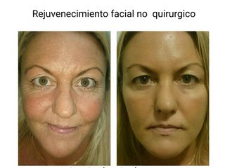 Rejuvenecimiento Facial Rellenos Faciales Botox Ácido Hialurónico Dr. Matías Bertera 