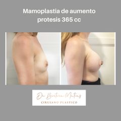 Aumento mamario retroglandular