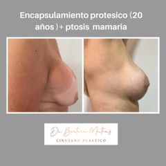 Correccion encapsulamiento mamario