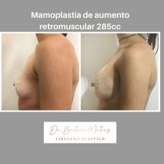Aumento mamario retromuscular