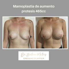Aumento mamario