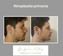 Rinoplastia - Dr. Matías Bertera