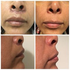 Lifting labios - Dr. Matías Bertera