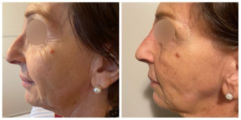 Rinomodelacion + botox - Dr. Matías Bertera