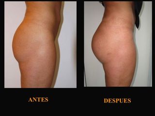 Aumento de glúteos