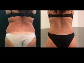 Lipoaspiración de espalda