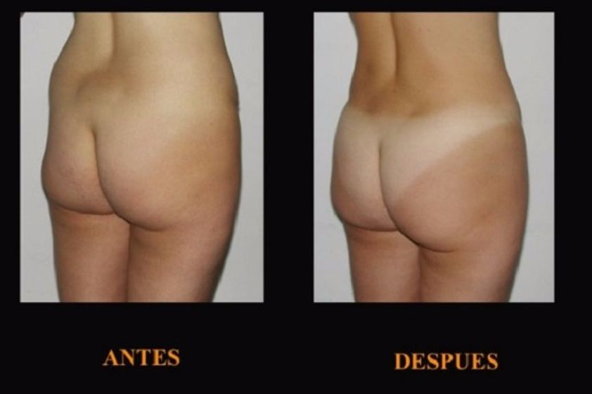 Aumento glúteos antes y después - 597870