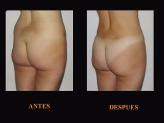 Antes y despues de Aumento gluteo con lipotransferencia