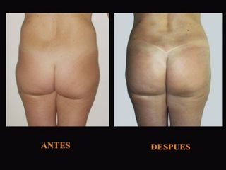 Antes y despues de Aumento gluteo con lipotransferencia