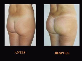 Antes y despues de Aumento gluteo con lipotransferencia