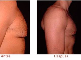 Antes y despues de ginecomastia