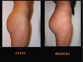 Antes y despues de gluteoplastia