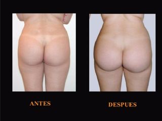 Antes y despues de gluteoplastia