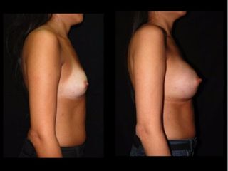 Antes y despues de implantes mamarios